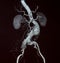 Abdominal Aortic Aneurysm, CT