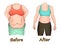 Abdominal fat of a woman before and after dieting, sport or surgery