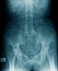 Abdominal xray