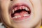 Abnormal boy tooth. The extra narrow strange tooth grew in the boy`s mouth. Boy shows his crooked tooth. Patient