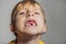 Abnormal boy tooth. The extra narrow strange tooth grew in the boy`s mouth. Boy shows his crooked tooth. Patient