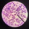 Abnormal cell blood smear science concept