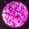 Abnormal cell blood smear science concept