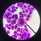 Abnormal cell blood smear science concept