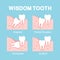 Abnormal eruption of wisdom tooth. Dental problems