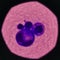 Abnormal malignant cells specimen pleural fluid.