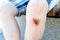 Abrasions, bruises on the knees of unrecognizable teenager. Life of teenagers, injuries, danger