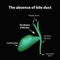 The absence of bile duct. Pathology of the gallbladder. Cholecystitis. The structure of the gallbladder. Infographics