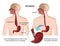 Achalasia of the esophagus 3d medical  illustration