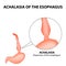 Achalasia of the esophagus. Expansion of the esophagus. Hernia. Infographics. Vector illustration on isolated background