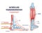 Achilles tendinopathy as injury to tendon in human heel outline diagram