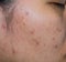 Acne and acne spot on oily face skin of Asian woman. Concept before acne treatment and face laser treatment for get rid of dark