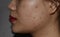 Acne , black spots and scars on face of Asian young woman