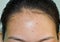 Acne , black spots and scars on forehead