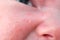 Acne on the face of a newborn child, close-up. Macro photos of skin defects in the baby