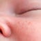 Acne on the face of a newborn child, close-up. Macro photos of skin defects in the baby