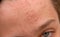 Acne forehead