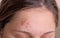 Acne on the girl\'s forehead