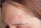 Acne on the girl\'s forehead