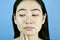 Acne scar skin facial problem, Asian woman annoy and bored about hormonal pimples.