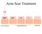 Acne scars. Laser scar atrophic treatment. The anatomical structure of the skin with acne. Vector illustration on