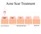 Acne scars. Laser scar atrophic treatment. The anatomical structure of the skin with acne. Vector illustration on