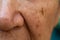 Acne, Small pimple is on senior woman nose, Deep groove cheeks, Close up and macro shot, Selective focus, Asian Body skin part