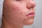 Acne. Teenage girl with the pimples on her face. Problematic skin. Close-up