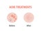 Acne treatments diagram illustration vector on white background, Beauty concept.