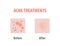 Acne treatments diagram illustration vector on white background, Beauty concept.