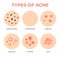 Acne types. Skin infection problem, pimples grade and type cyst, whitehead, blackheads, nodule and cystic. Dermis pore