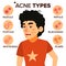 Acne Types Vector. Boy With Acne. Pimples, Wrinkles, Dry Skin, Blackheads. Isolated Flat Cartoon Character Illustration