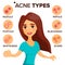 Acne Types Vector. Girl With Acne. Skin Care. Treatment, Healthy. Nodule, Whitehead. Isolated Flat Cartoon Character