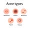 Acne types vector illustration.