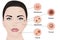 Acne types vector illustration. Cosmetology