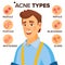 Acne Types Vector. Man With Acne. Facial Skin Problems. Papule, Pustulem Scards. Isolated Flat Cartoon Character