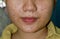 acne vulgaris and black spots over whole face of Asian woman. Acne occurs when hair follicles become plugged with oil and dead