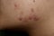 Acne vulgaris, black spots and scars on face of Asian young woman