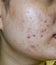 acne vulgaris and scars over whole face of Asian woman. Acne occurs when hair follicles become plugged with oil and dead cells. It