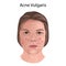 Acne vulgaris. Young woman face with skin inflammation.