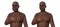 Acromegaly in a man, and the same healthy person, 3D illustration