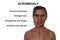 Acromegaly in a man, and the same healthy person, 3D illustration