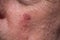 Actinic keratosis or sunspots on sun-damaged skin