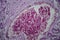 Acute glomerulonephritis, light micrograph