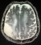 Acute infarction brain mri examination stroke