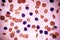 Acute lymphoblastic leukemia