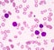 Acute lymphoblastic leukemia(ALL)