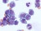 Acute myeloid leukemia with central nervous system involvement