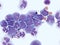 Acute myeloid leukemia in cerebrospinal fluid