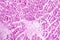 Acute myocardial infarction, histology of heart tissue